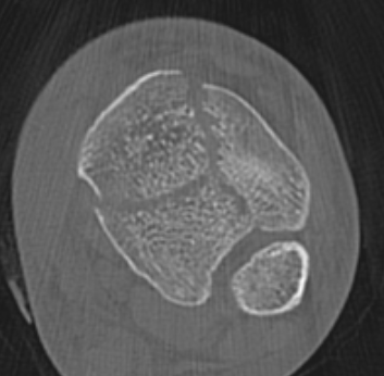 Tibial plafond common fragments